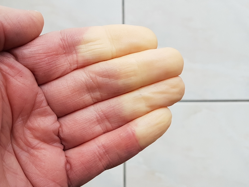 raynaud.jpg